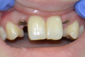  After implant placement