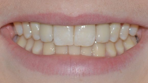  Implant retained crowns