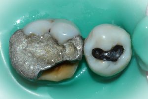  Old Amalgam fillings