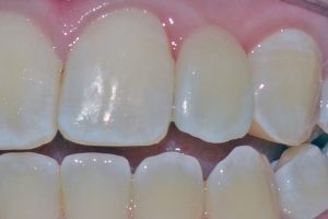  Bridge to replace tooth