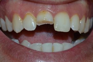  Fractured front tooth