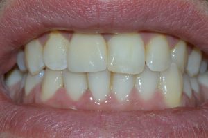  Aesthetic porcelain crown