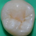 Before Fissure Sealant