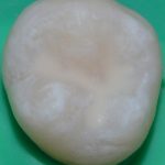 After Fissure Sealant